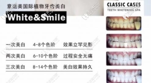 深圳正夫口腔植物牙齒美白優(yōu)勢(shì)