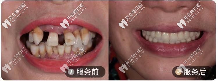 50歲阿姨，做的ALL-ON-4種植牙對比圖