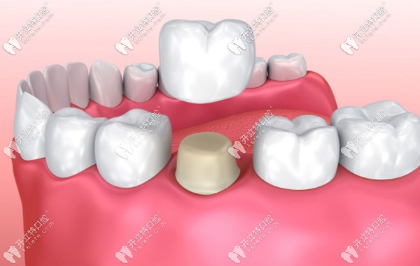德國威蘭德全瓷牙冠多少錢一顆?收我3500塊是不是貴了點
