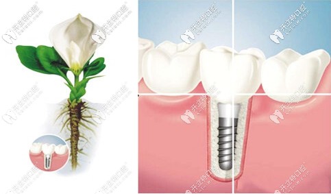 國產(chǎn)和韓系種植牙如登騰奧齒泰哪個(gè)較便宜？4000塊就能種的