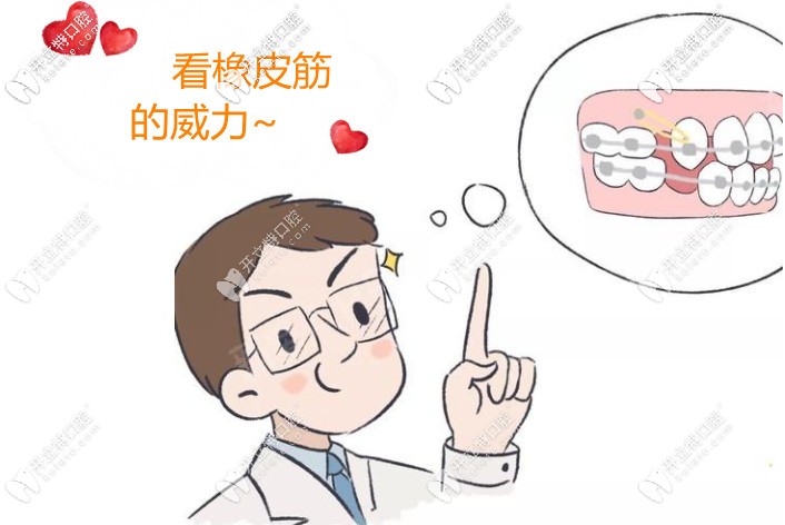 利用橡皮筋達(dá)到牙齒移動(dòng)的目的