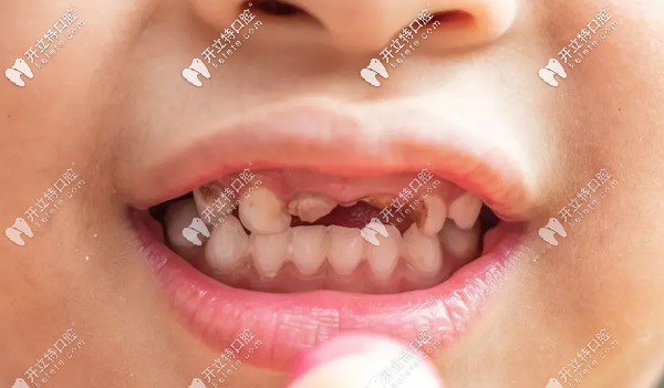 大部分早失的原因是齲病