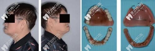 【病例分享】韓國(guó)奧齒泰種植體做全口桿卡式覆蓋義齒修復(fù)