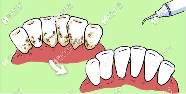 洗牙多久洗一次