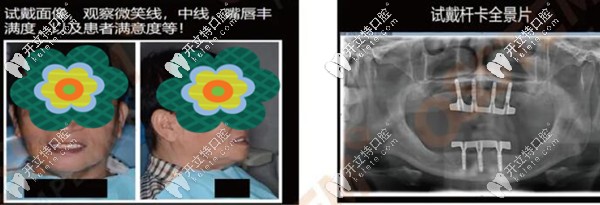 韓國奧齒泰種植體做全口桿卡式覆蓋義齒修復案例