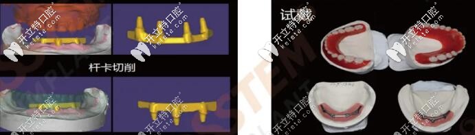 全口桿卡式種植牙手術過程