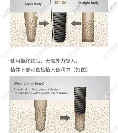 美國(guó)皓圣ETIII SA種植體的優(yōu)勢(shì)