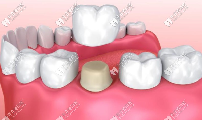 全瓷牙冠 全瓷牙冠