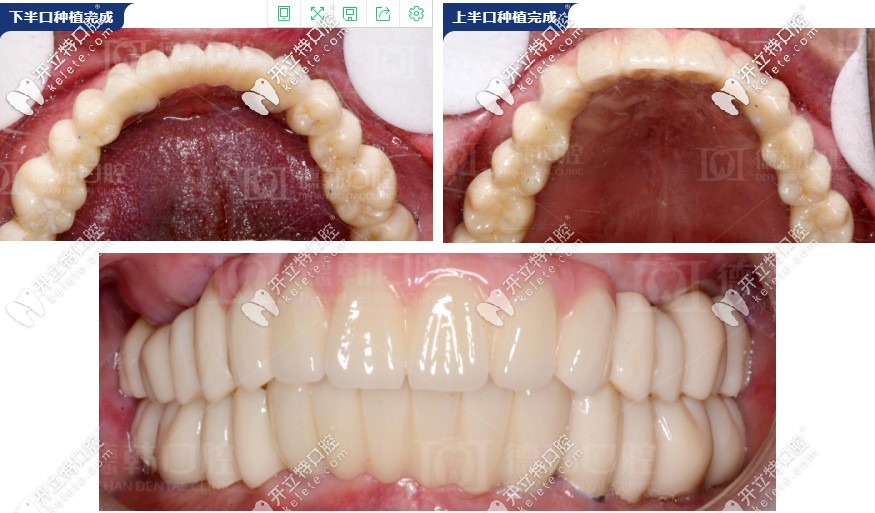 種牙成功后的效果