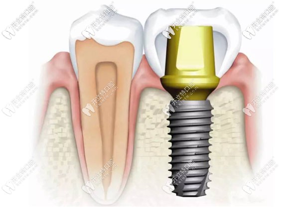 廣州天河區(qū)牙科做種植牙的費用 廣州天河區(qū)牙科做種植牙的費用