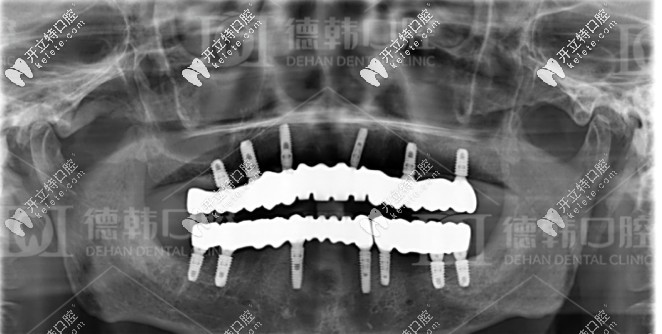 種牙成功后的牙片