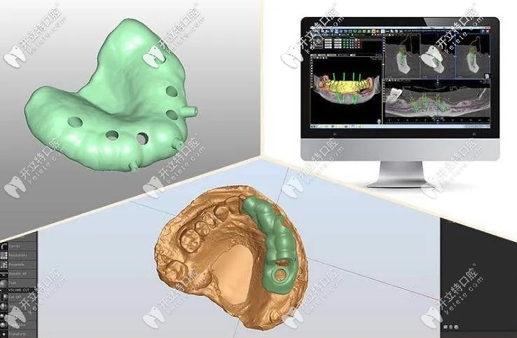 3D數(shù)字化種植導(dǎo)板