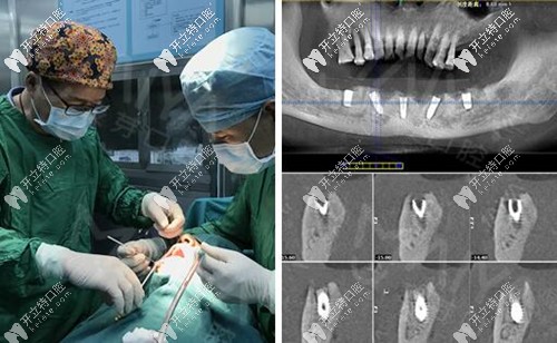 只需5顆種植體就能恢復(fù)半口牙齒 只需5顆種植體就能恢復(fù)半口牙齒
