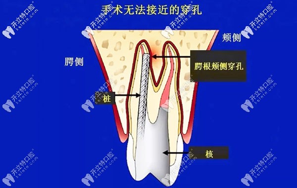 意向性再植術(shù)的適應(yīng)癥