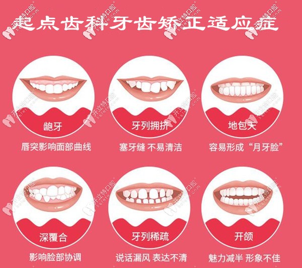 深圳起點(diǎn)口腔牙齒矯正多少錢 深圳起點(diǎn)口腔牙齒矯正多少錢