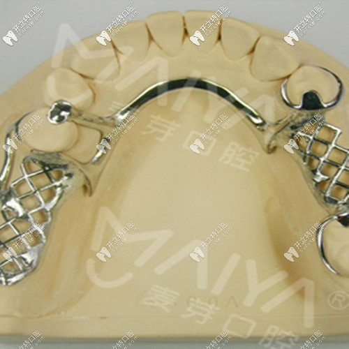 掛鉤活動(dòng)假牙 掛鉤活動(dòng)假牙