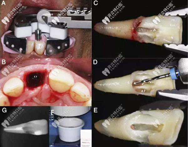 意向性再植術(shù)過程圖解