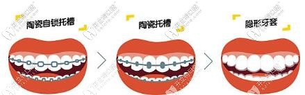 牙齒矯正牙套種類(lèi)