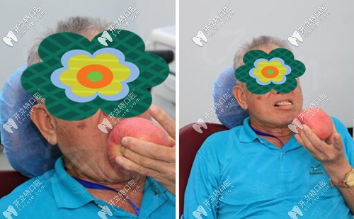 深圳麥芽口腔下半口架橋式種植牙<span style= 深圳麥芽口腔下半口架橋式種植牙<span style=