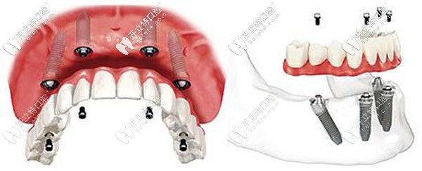 全口種植中桿卡和馬龍橋修復(fù)的區(qū)別大嗎,制作流程可知一二
