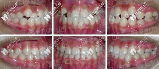 反頜牙列擁擠矯正前后對比 反頜牙列擁擠矯正前后對比