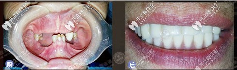 種植牙前后對(duì)比