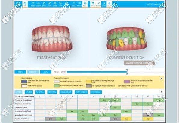 來認(rèn)識下-隱適美itero口掃儀or丹麥3shape口腔掃描的區(qū)別吧