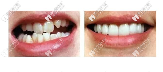 牙齒矯正案例二