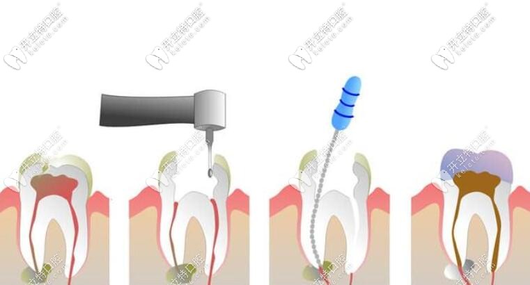 疑難根管治療 疑難根管治療