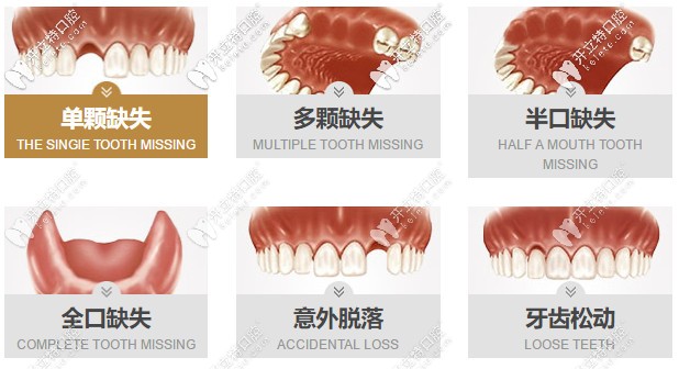 種植牙的適應(yīng)癥狀
