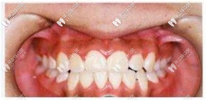 矯正后的牙齒變整齊了 矯正后的牙齒變整齊了