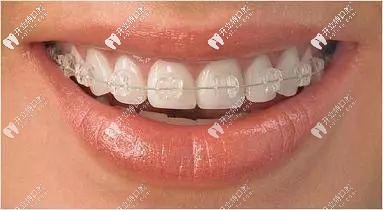 陶瓷半隱形矯正