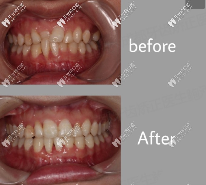 鮑醫(yī)生矯正案例