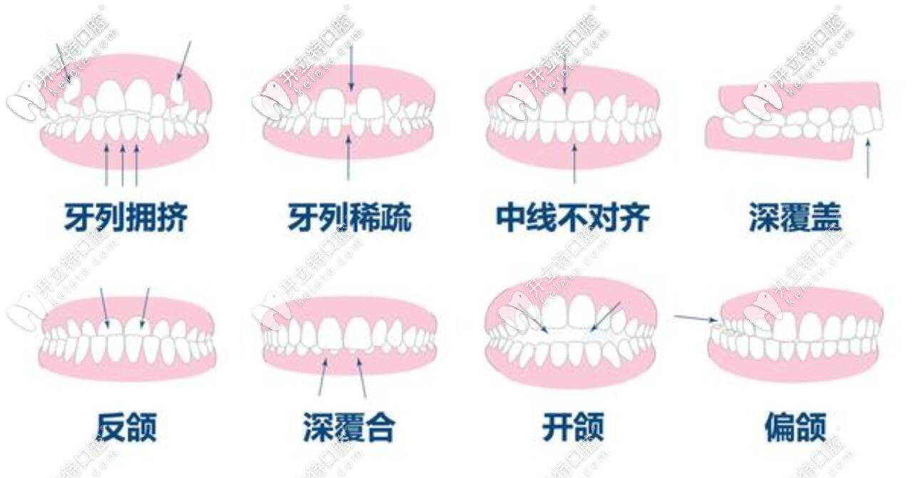 牙齒不齊的危害