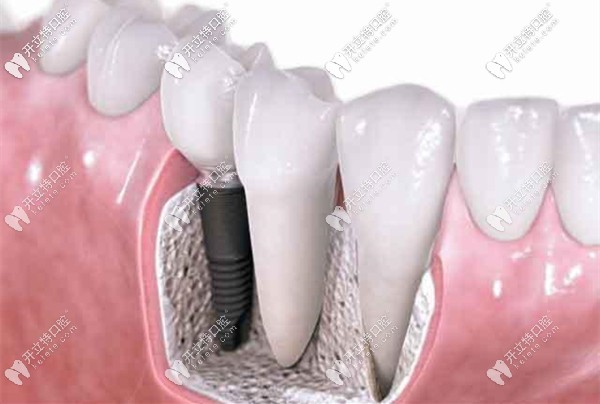 廣州廣大口腔的韓國登騰和奧齒泰價格