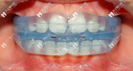 兒童牙齒干預(yù)器圖片