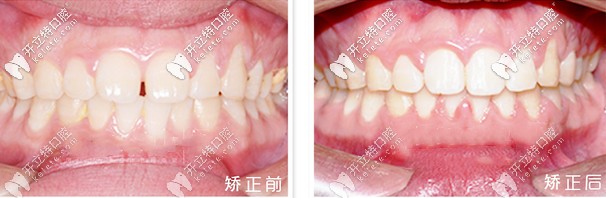 矯正前后對(duì)比