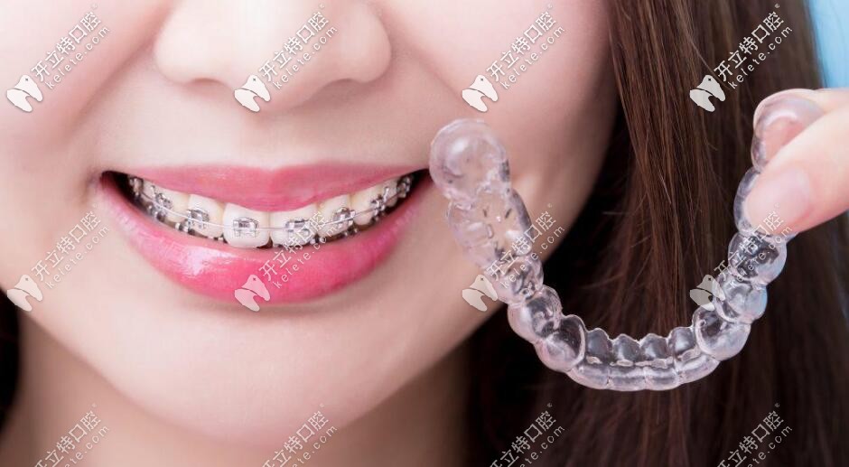 金屬矯正和隱形矯正 金屬矯正和隱形矯正