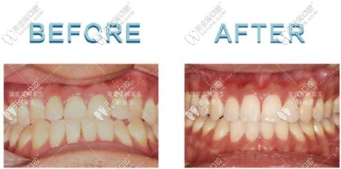 骨性地包天矯正后牙齒的變化 骨性地包天矯正后牙齒的變化