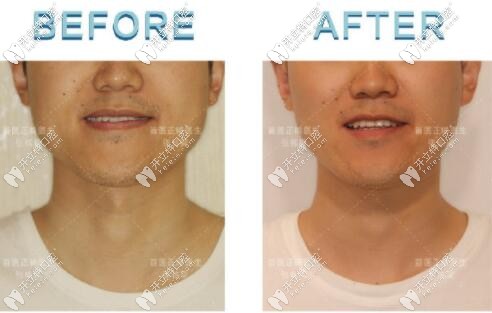 成人骨性地包天矯正后正臉變化對(duì)比 成人骨性地包天矯正后正臉變化對(duì)比