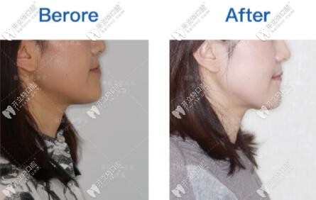 小姐姐矯正地包天后側(cè)臉的對(duì)比圖 小姐姐矯正地包天后側(cè)臉的對(duì)比圖