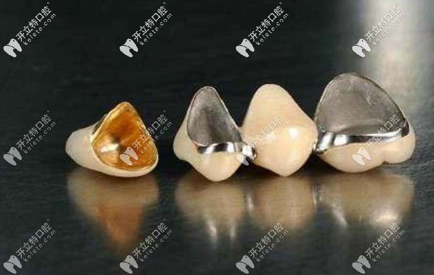 烤瓷牙600和800元、1200塊的區(qū)別在哪？?jī)r(jià)格貴質(zhì)量就好？