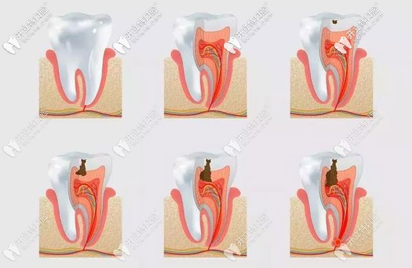 牙齒齲壞過程圖