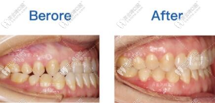 牙齒基本上也解除了反頜 牙齒基本上也解除了反頜