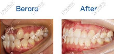 首<!--<i data=20240703-sp></i>-->張棟梁矯正案例對(duì)比 首<!--<i data=20240703-sp></i>-->張棟梁矯正案例對(duì)比