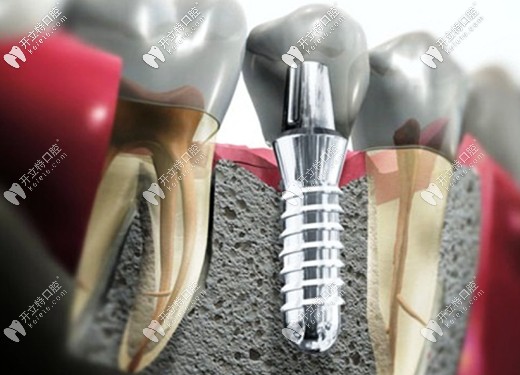 在廣州市荔灣區(qū)做一顆種植牙大概需要多少錢