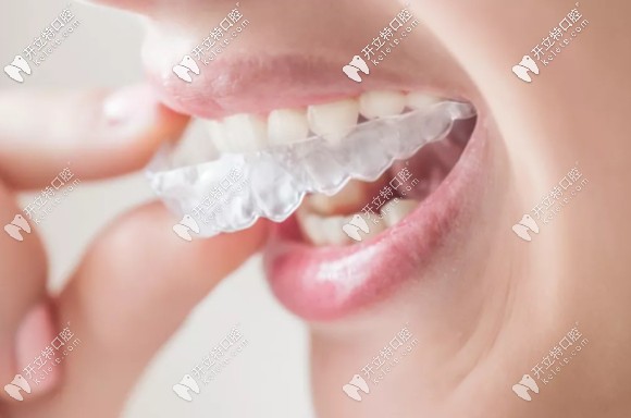 王釗偉醫(yī)生淺析隱適美和時(shí)代天使及正雅的優(yōu)勢(shì)