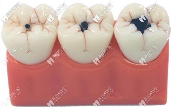 牙齒上面有小黑點(diǎn)怎么辦