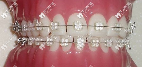 陶瓷自鎖托槽矯正