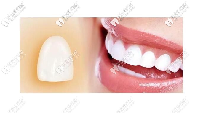 牙齒貼面